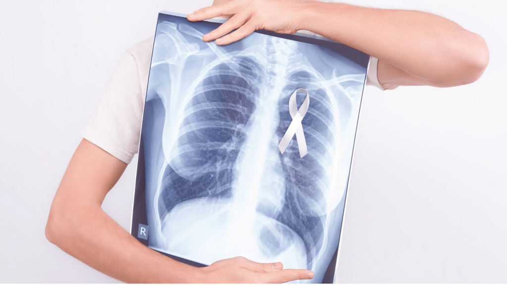 Person holding chest x-ray showing lung cancer